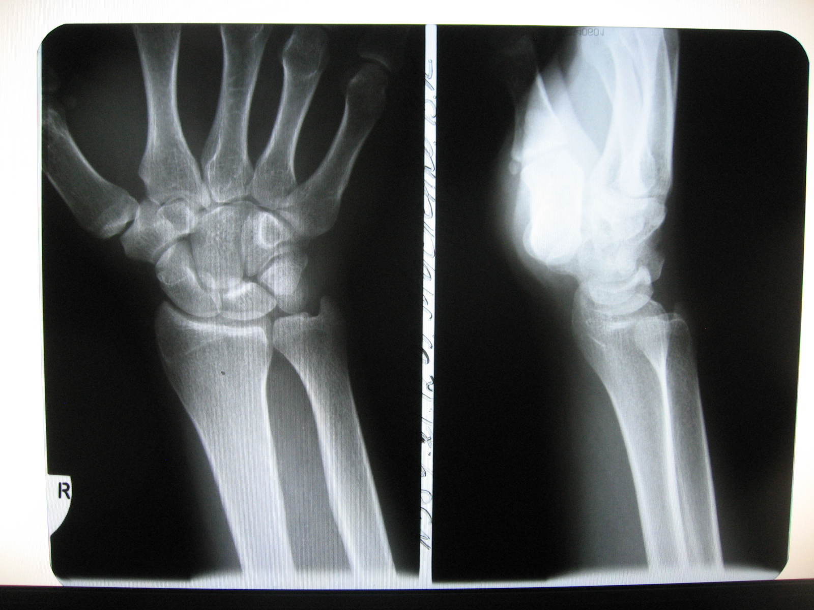 Синостоз 1 пястной кости на рентгене кисти. Лучезапястный кость фото. Ладьевидная кость кисти рентген. Рентгенограмм норма лучевой кости. Рентгенограмма лучезапястного сустава.